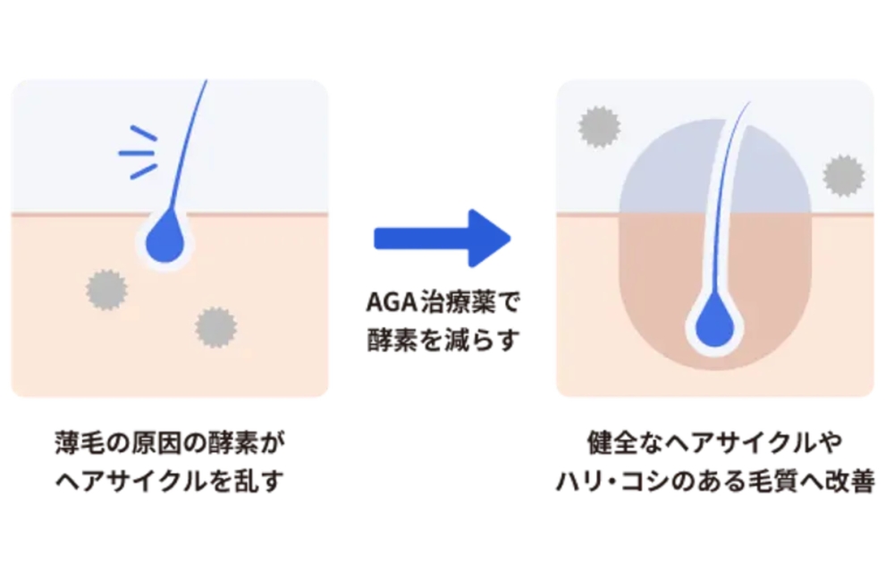 レバクリのAGA治療 守りの治療