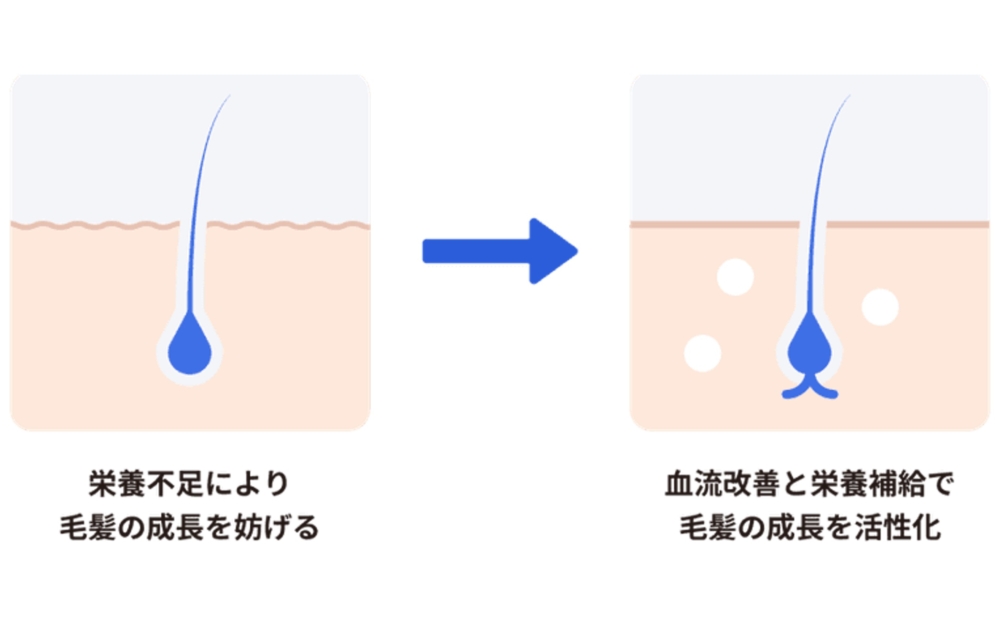 レバクリのAGA治療 攻めの治療