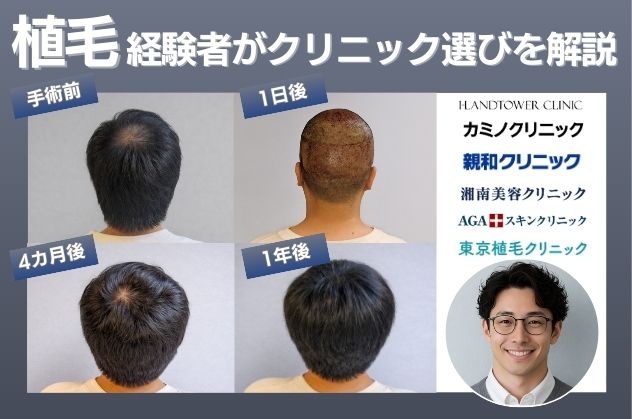 東京のおすすめ植毛クリニック！植毛経験者がクリニックの選び方を解説