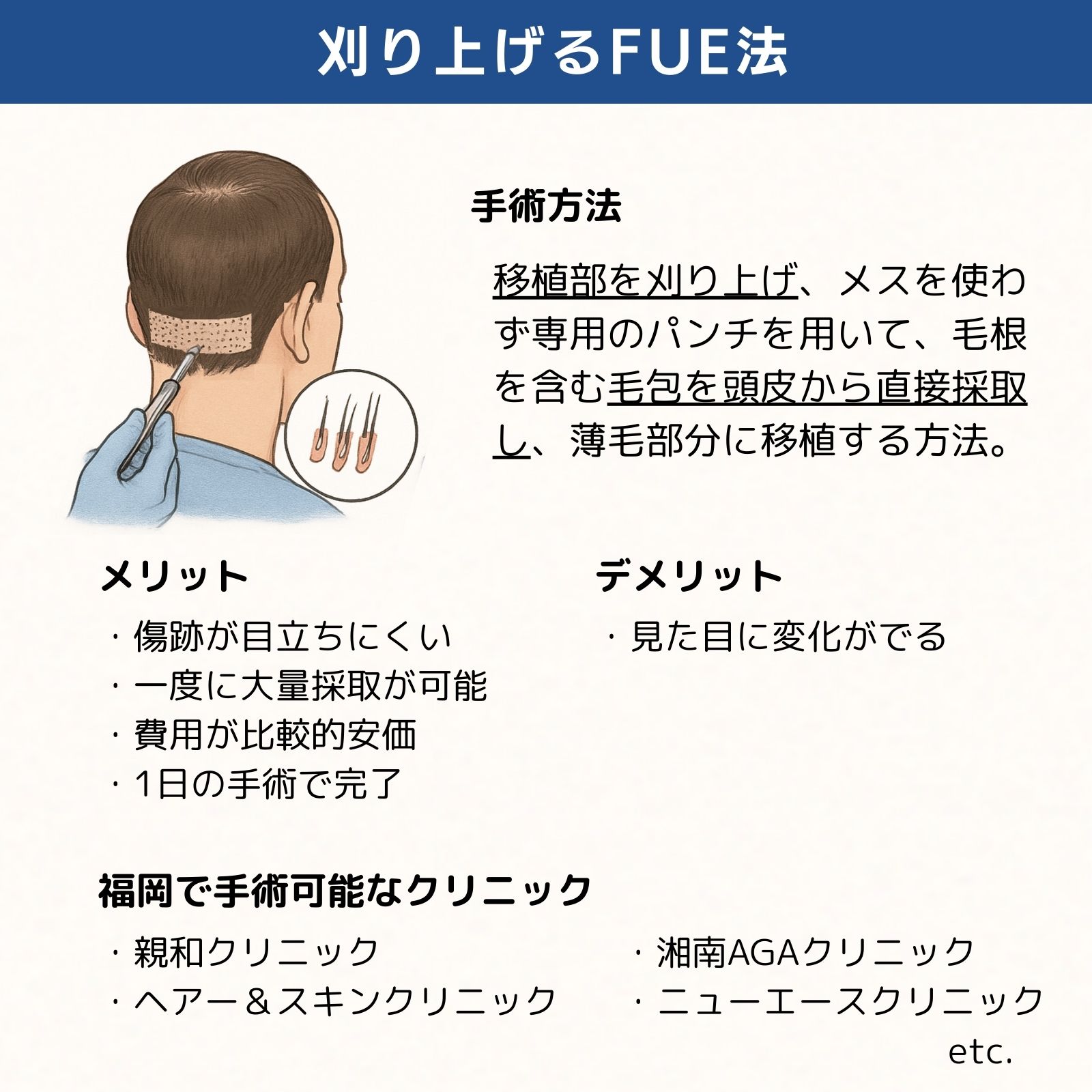 福岡刈り上げるFUE法