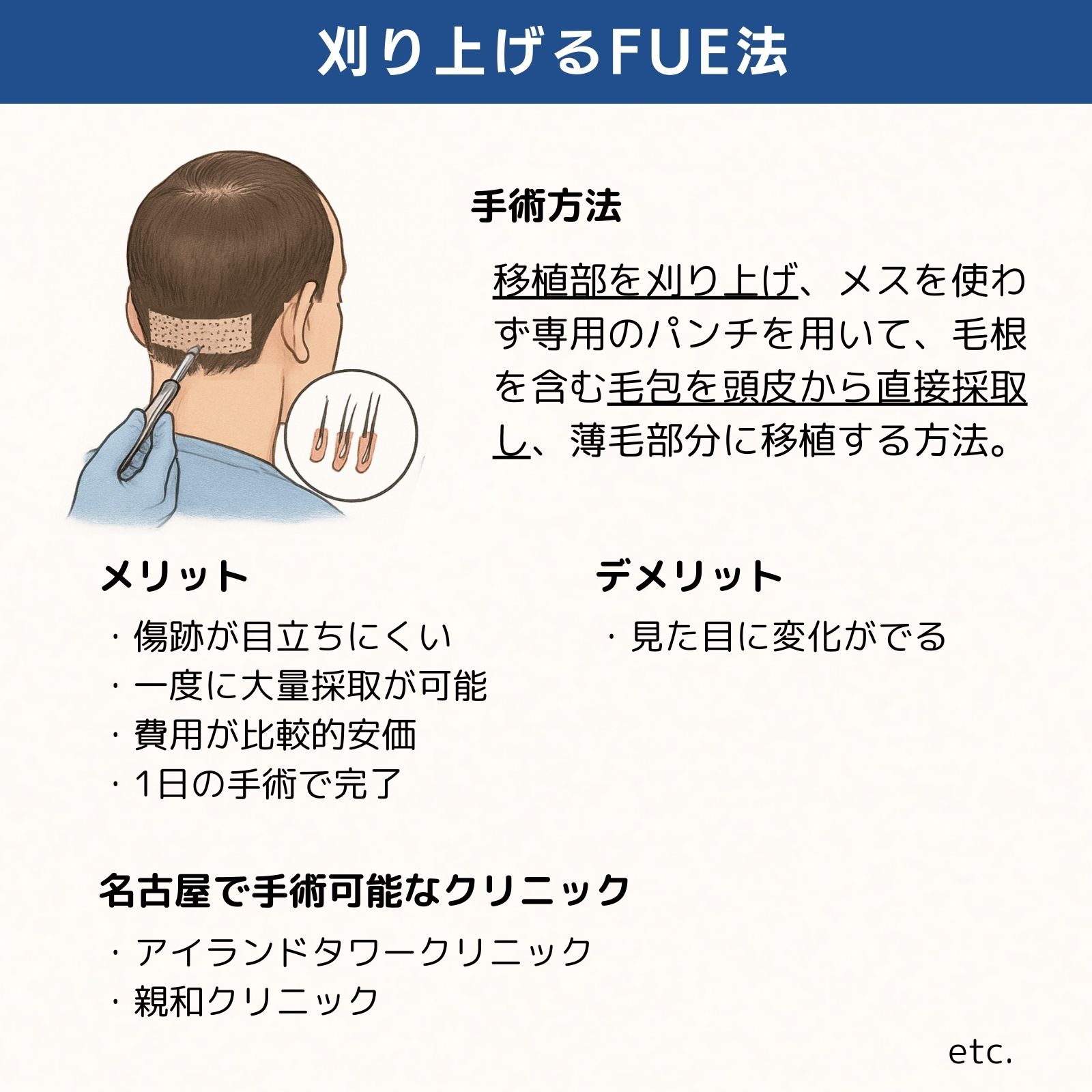 名古屋刈り上げるFUE法