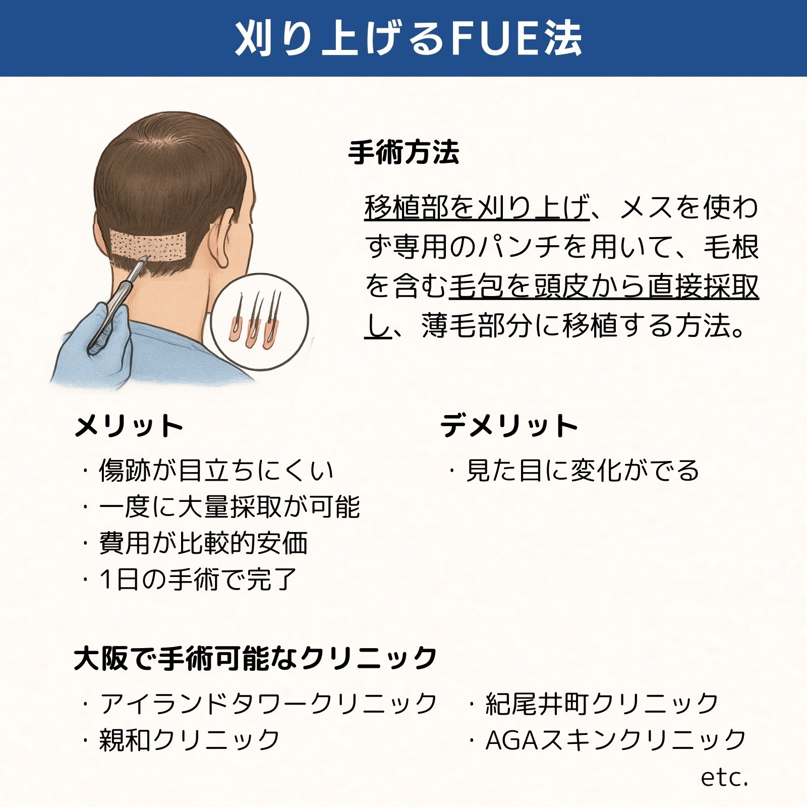 刈り上げるFUE法