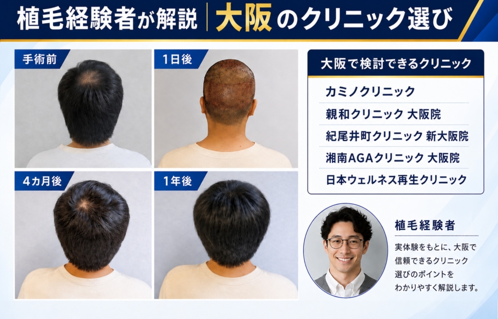 植毛経験者が解説する大阪でのクリニック選び